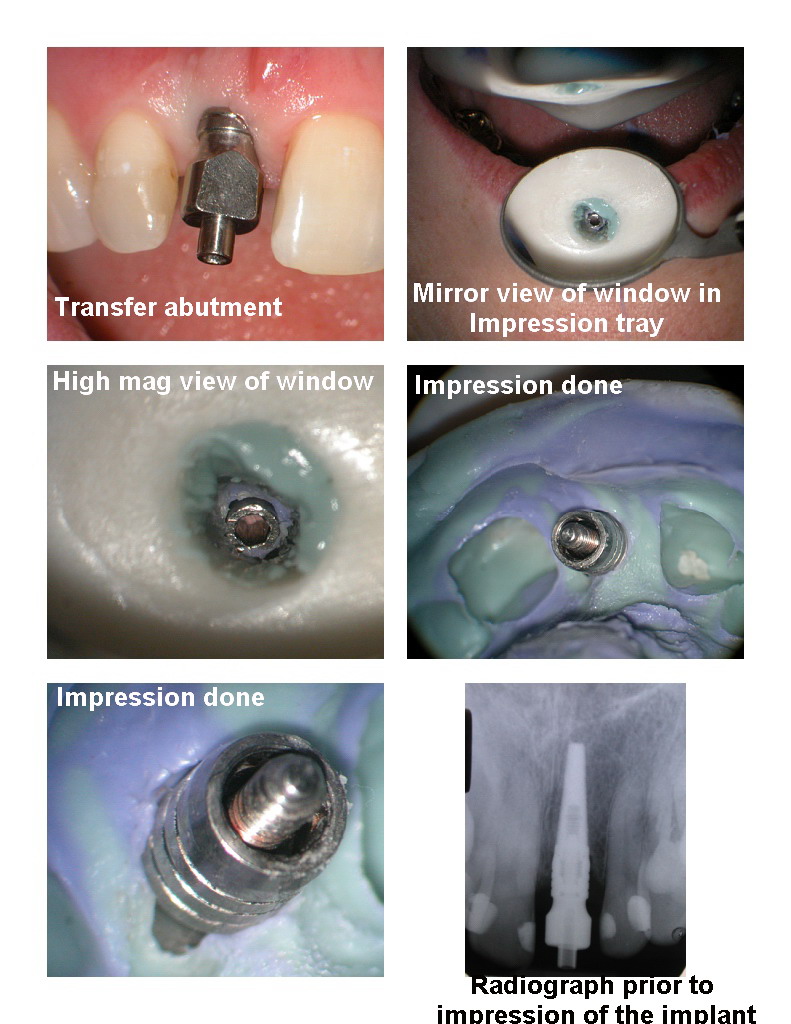 Implant impression pg 2.jpg